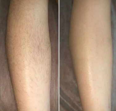 Antes e depois — Perna